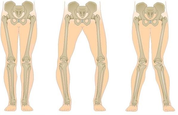 Types d'arthrose