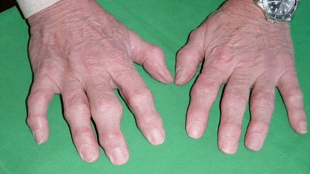 Maladies conjointes