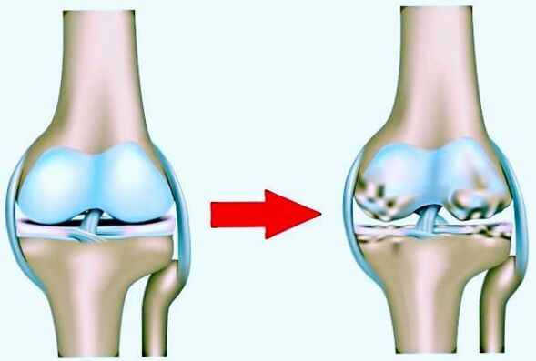 Articulation du genou normal et affectée par l'arthrose