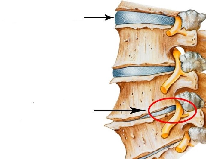 Disque et nerf endommagés par ostéochondrose cervicale