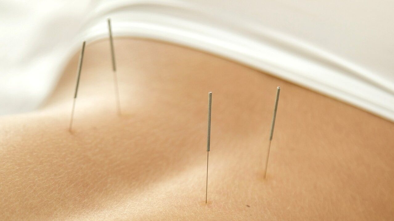 L'acupuncture aidera à éliminer les douleurs lombaires